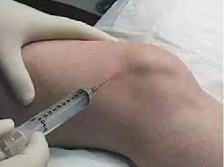 關(guān)節(jié)腔穿刺灌注治療.png 關(guān)節(jié)腔穿刺灌注治療.png