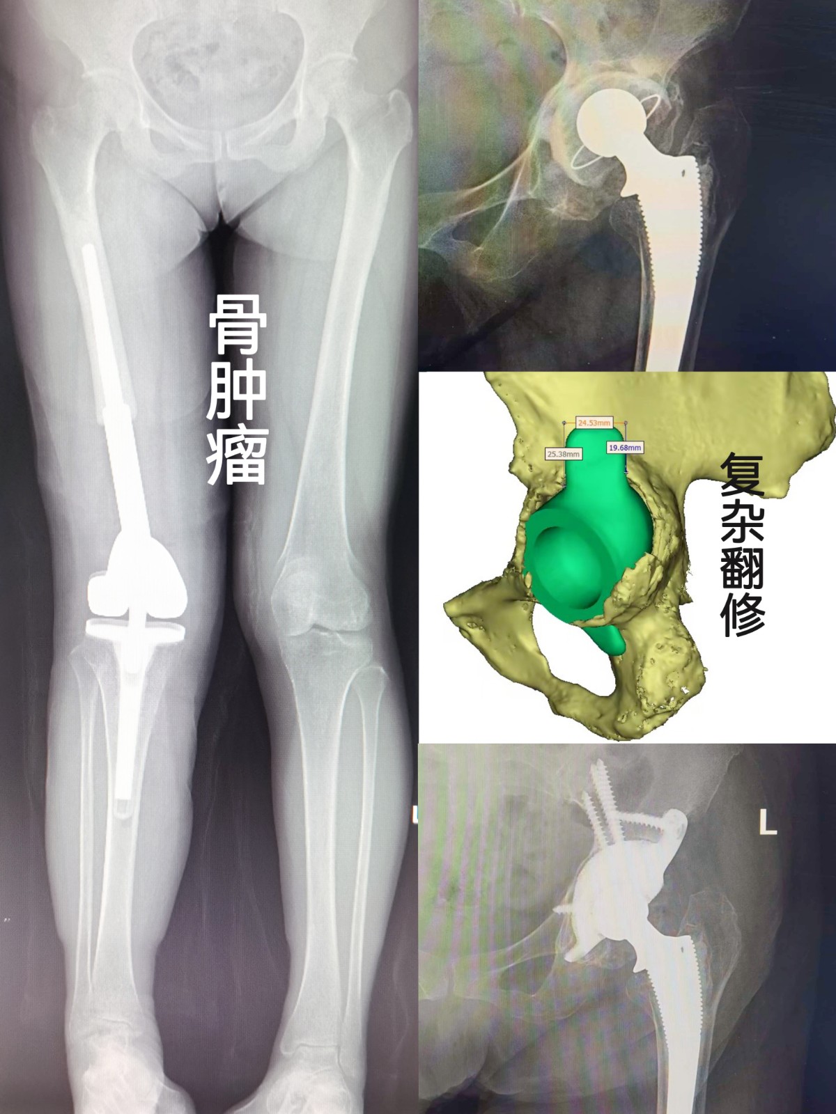 復雜髖翻修.jpg 復雜髖翻修.jpg