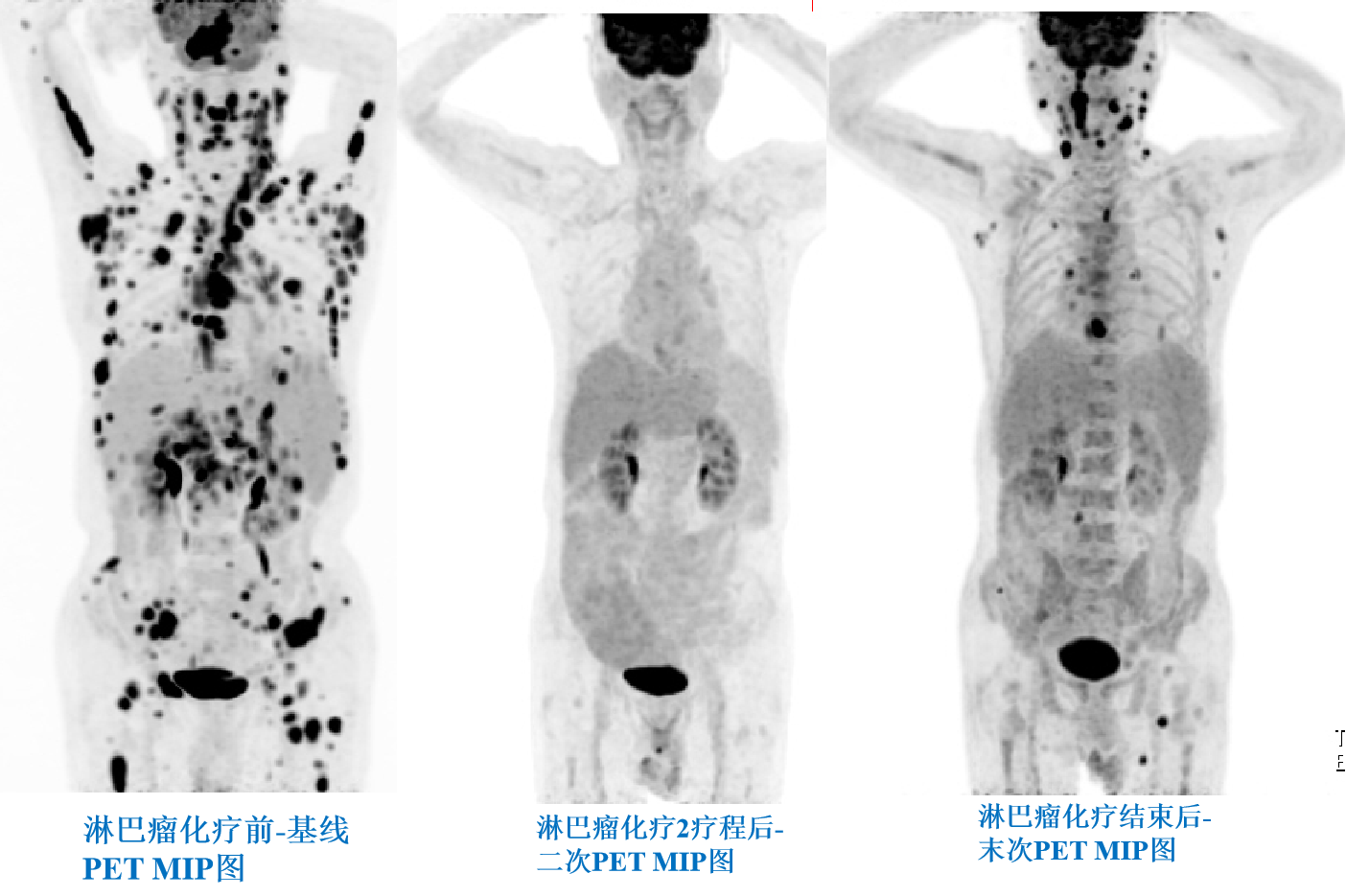 淋巴瘤化療前、中、后PETCT療效評價.png