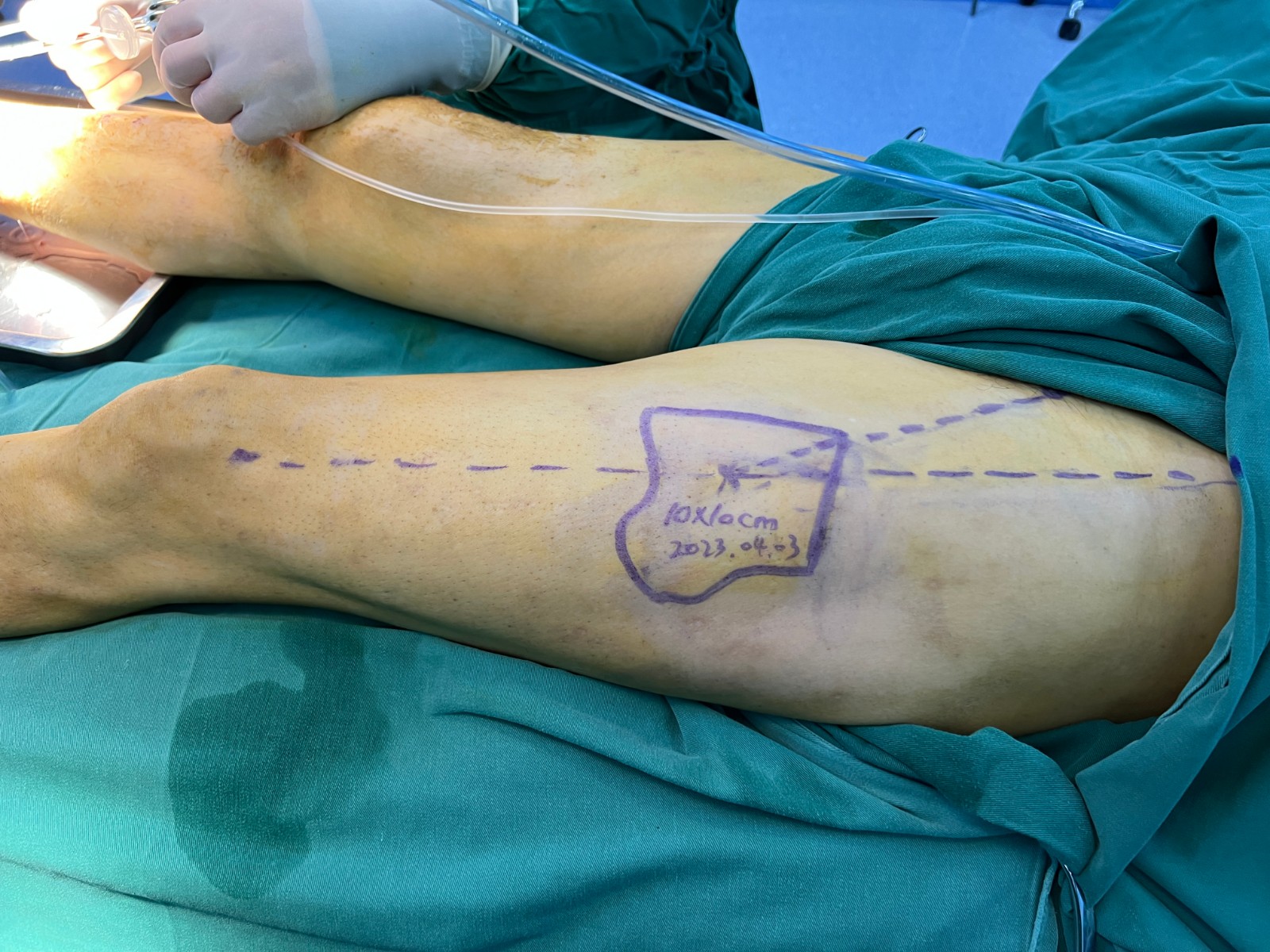 游離皮瓣修復(fù)骨外露創(chuàng)面2.jpg 游離皮瓣修復(fù)骨外露創(chuàng)面2.jpg