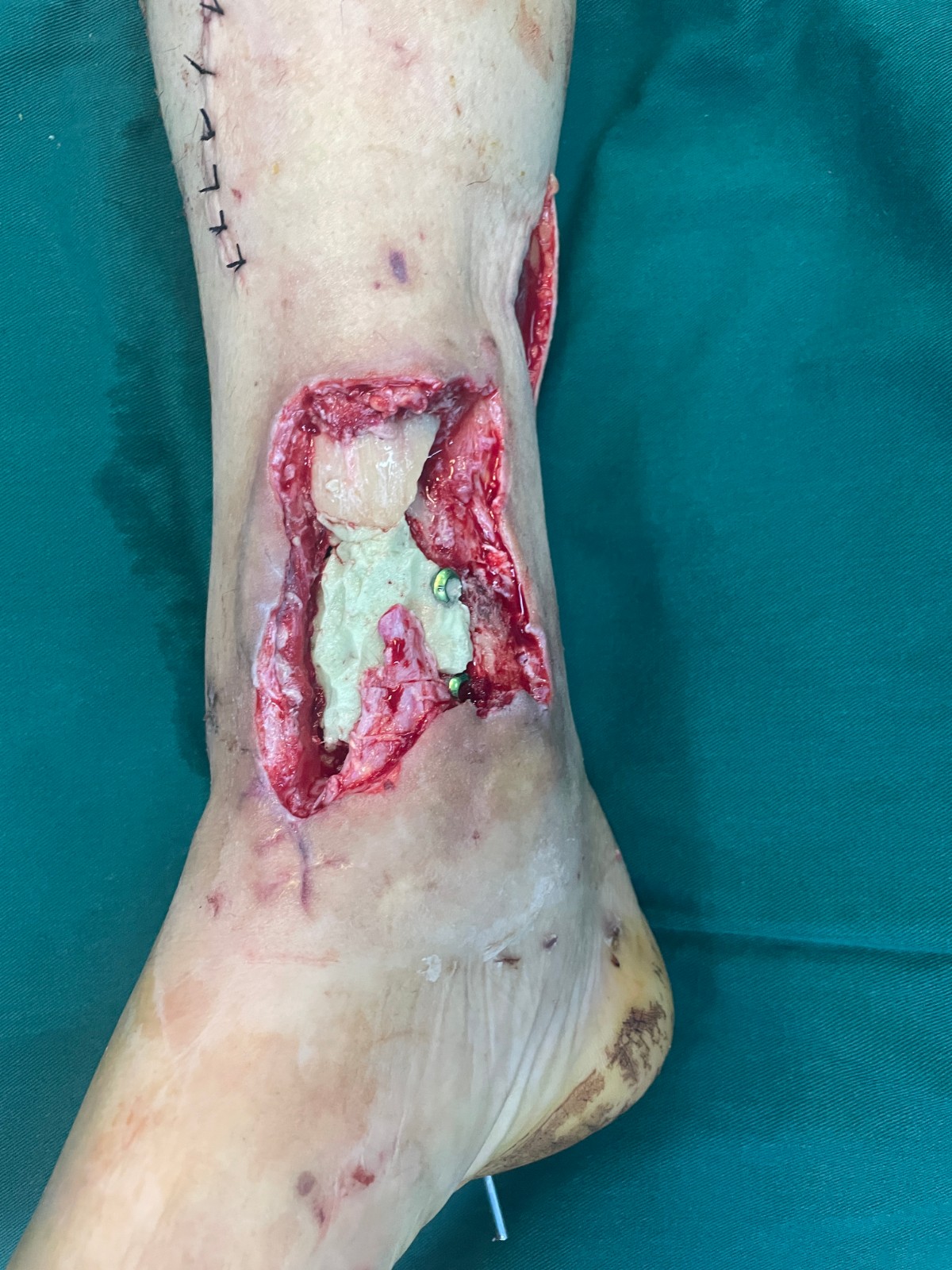 游離皮瓣修復(fù)骨外露創(chuàng)面1.jpg 游離皮瓣修復(fù)骨外露創(chuàng)面1.jpg