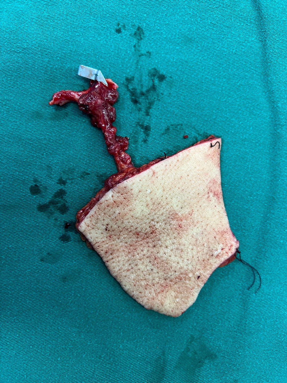 游離皮瓣修復(fù)骨外露創(chuàng)面3.jpg 游離皮瓣修復(fù)骨外露創(chuàng)面3.jpg